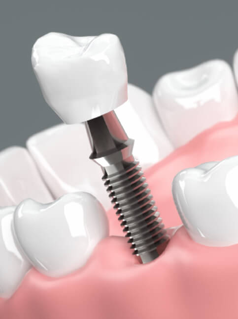 インプラント